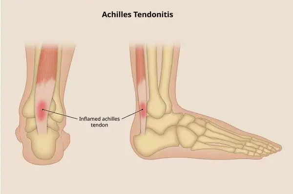التهاب تاندون آشیل