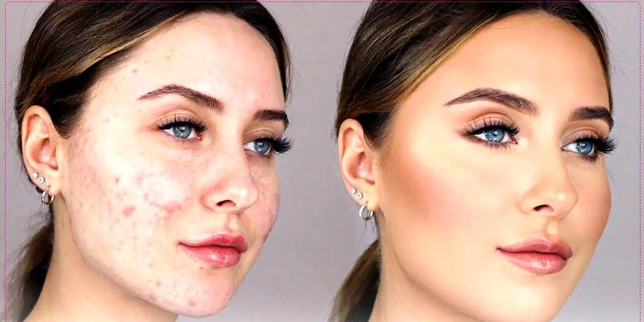 چجوری جوش ها رو با آرایش مخفی کنیم؟! | بیا تا فون و فن کار رو بهت بگم!