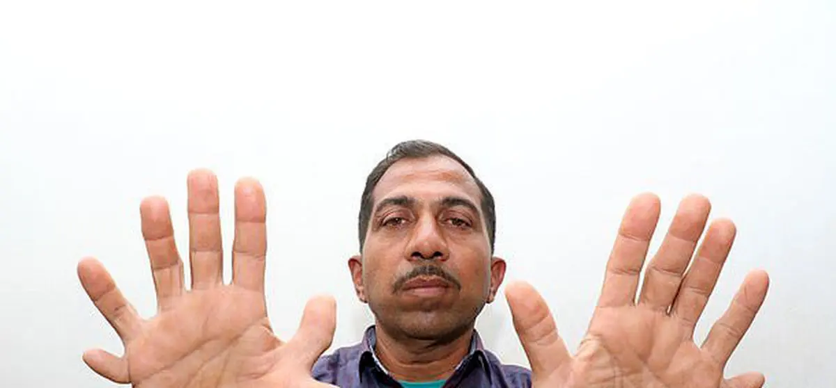 مردی که بیشترین انگشت در جهان رو داره + تصاویر