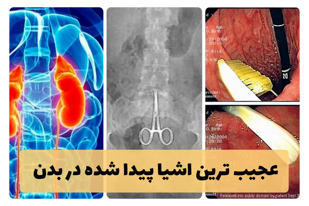 عجیب ترین اشیا پیدا شده در بدن