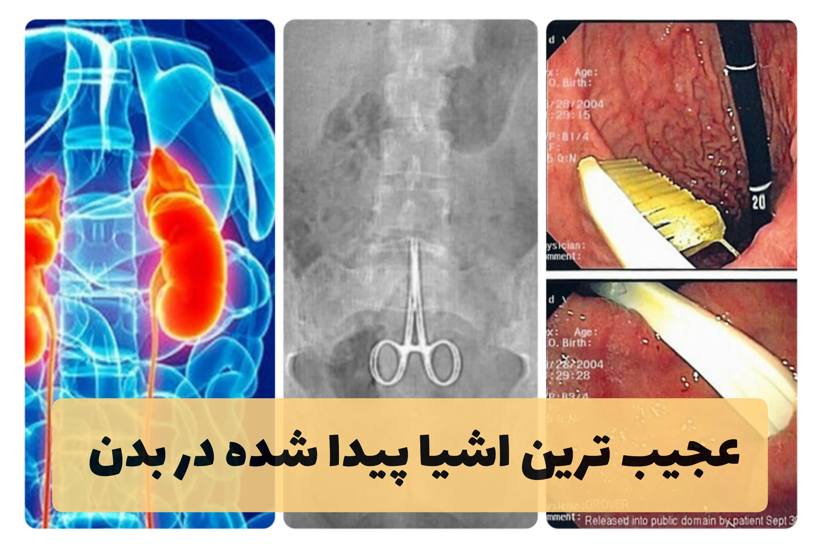 عجیب ترین چیزایی که در بدن آدما پیدا شده؛ از بچه سنگی تا گیاه نخود!
