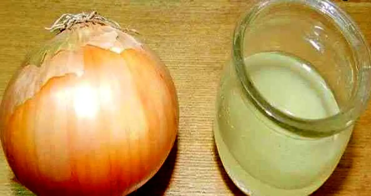 ریزش مو