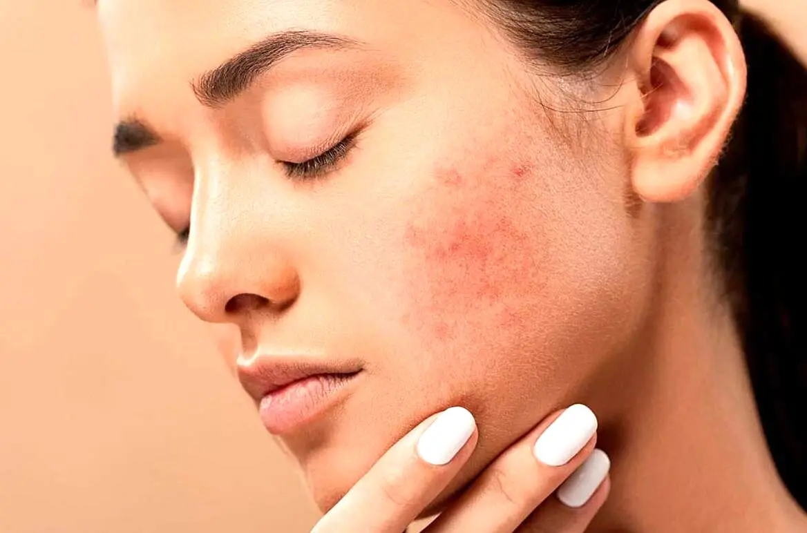 جوش روی هر قسمت صورت نشانه چیست؟ | از بین بردن جوش جاهای مختلف صورت
